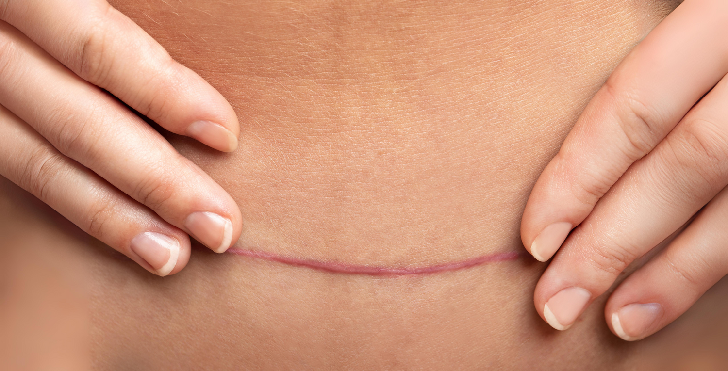 Image depicting scar reduction, c section scar repair